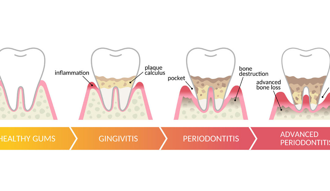 The Truth About Gum Disease